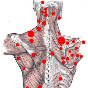 044 Trigger Points: An Investigation of Dry Needling, Intra-Muscular Therapy and Acupuncture • Josh Lerner